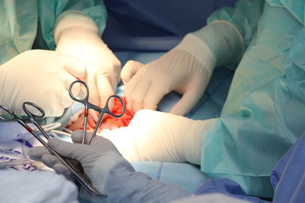 Sterilizáció műtétje